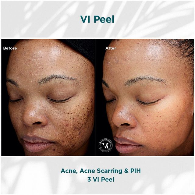 Chemical Peels Philadelphia Pa Facial peel to help improve skin